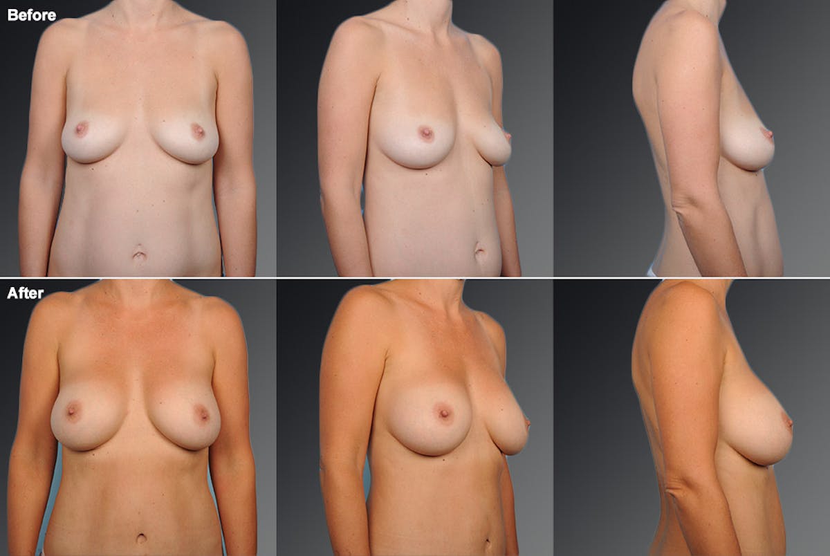 Breast Augmentation Before & After Gallery - Patient 104109192 - Image 1