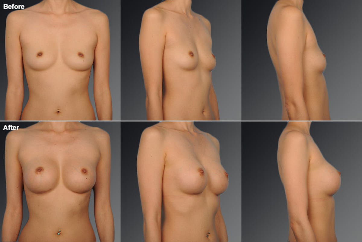 Breast Augmentation Before & After Gallery - Patient 104109193 - Image 1