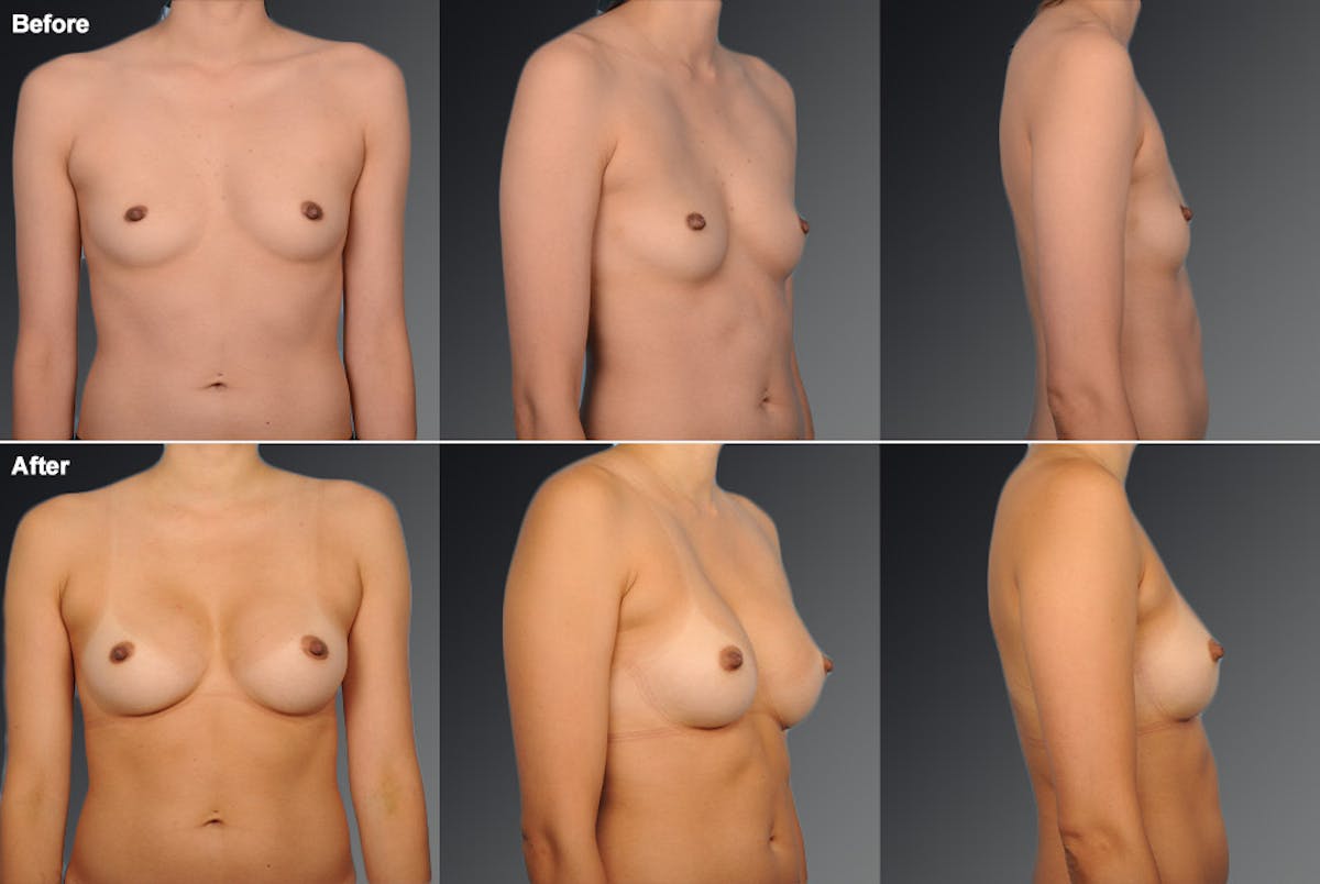 Breast Augmentation Before & After Gallery - Patient 104110520 - Image 1
