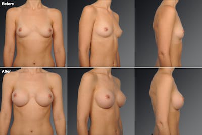 Breast Augmentation Before & After Gallery - Patient 104110523 - Image 1