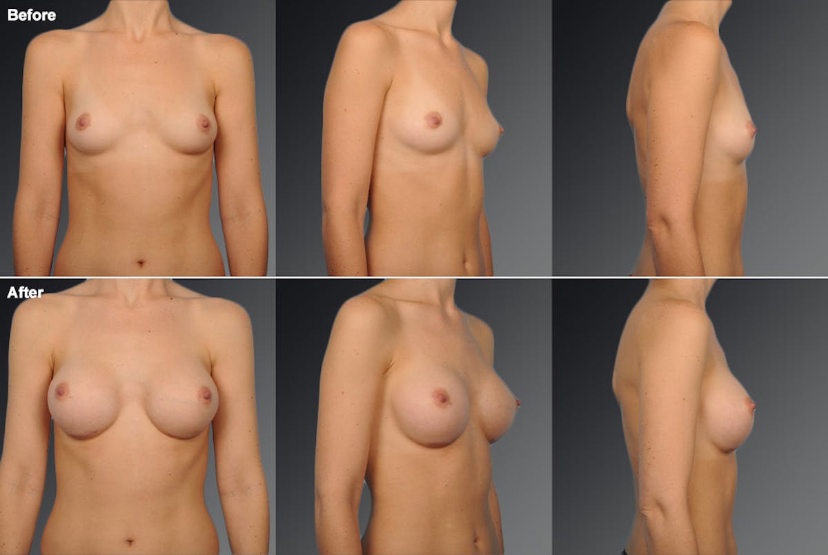 Breast Augmentation Before & After Gallery - Patient 104110523 - Image 1