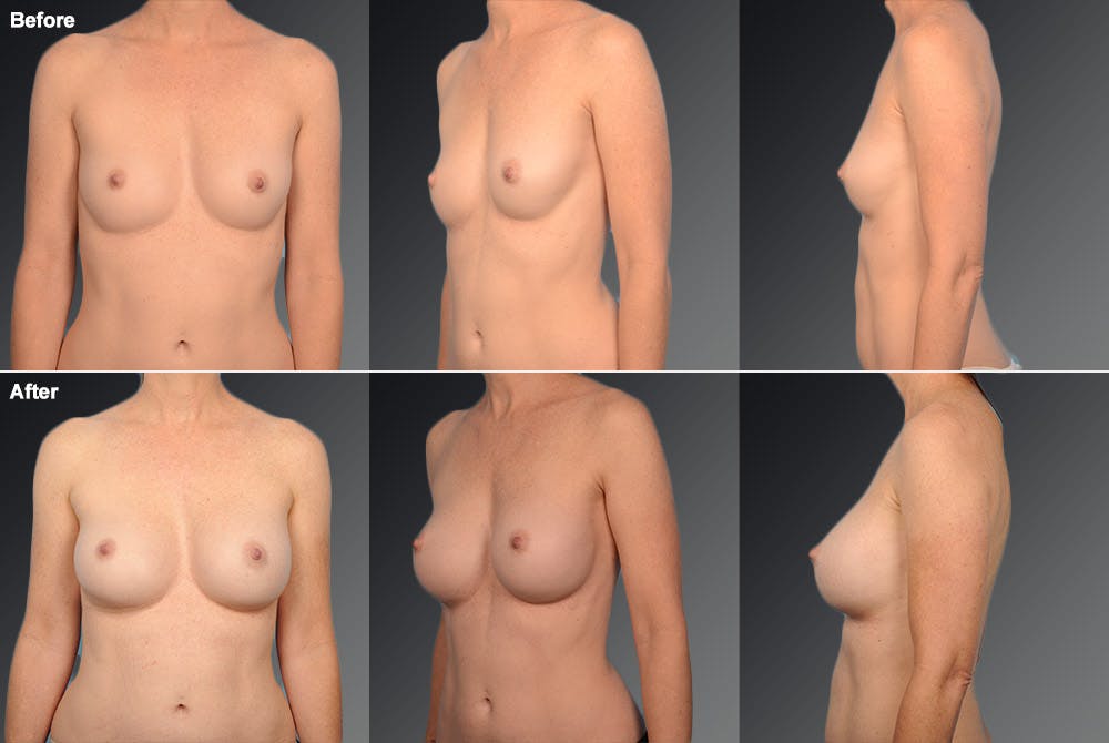 Breast Augmentation Before & After Gallery - Patient 104110524 - Image 1
