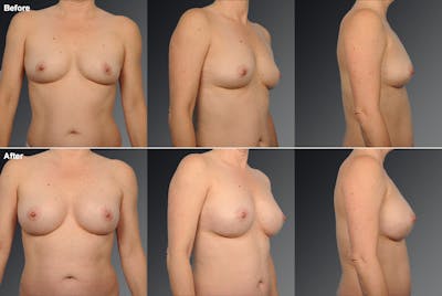 Breast Augmentation Before & After Gallery - Patient 104110525 - Image 1