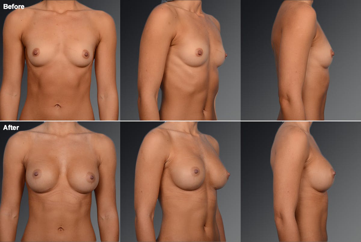 Breast Augmentation Before & After Gallery - Patient 104110526 - Image 1