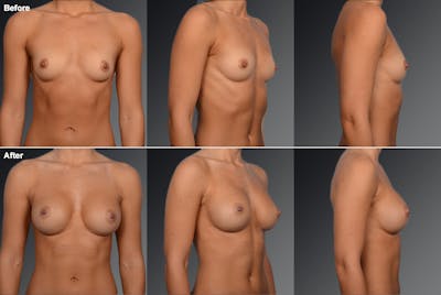 Breast Augmentation Before & After Gallery - Patient 104110526 - Image 1