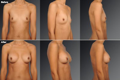 Breast Augmentation Before & After Gallery - Patient 104110531 - Image 1