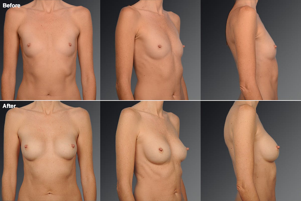 Breast Augmentation Before & After Gallery - Patient 104110537 - Image 1