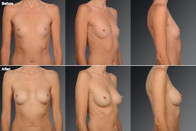 Breast Augmentation Before & After Gallery - Patient 104110537 - Image 1