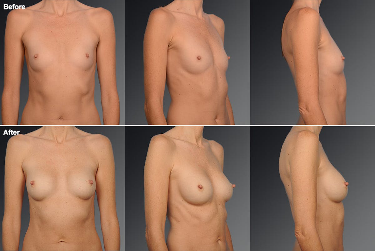 Breast Augmentation Before & After Gallery - Patient 104110537 - Image 1