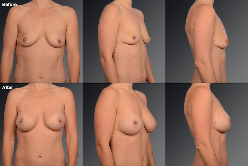 Breast Augmentation Before & After Gallery - Patient 104110538 - Image 1