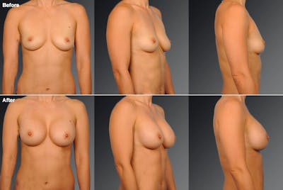 Breast Augmentation Before & After Gallery - Patient 104110562 - Image 1