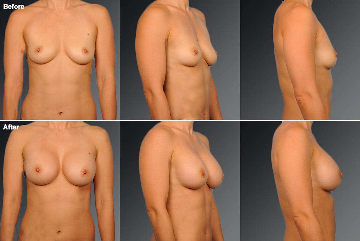 Breast Augmentation Before & After Gallery - Patient 104110562 - Image 1