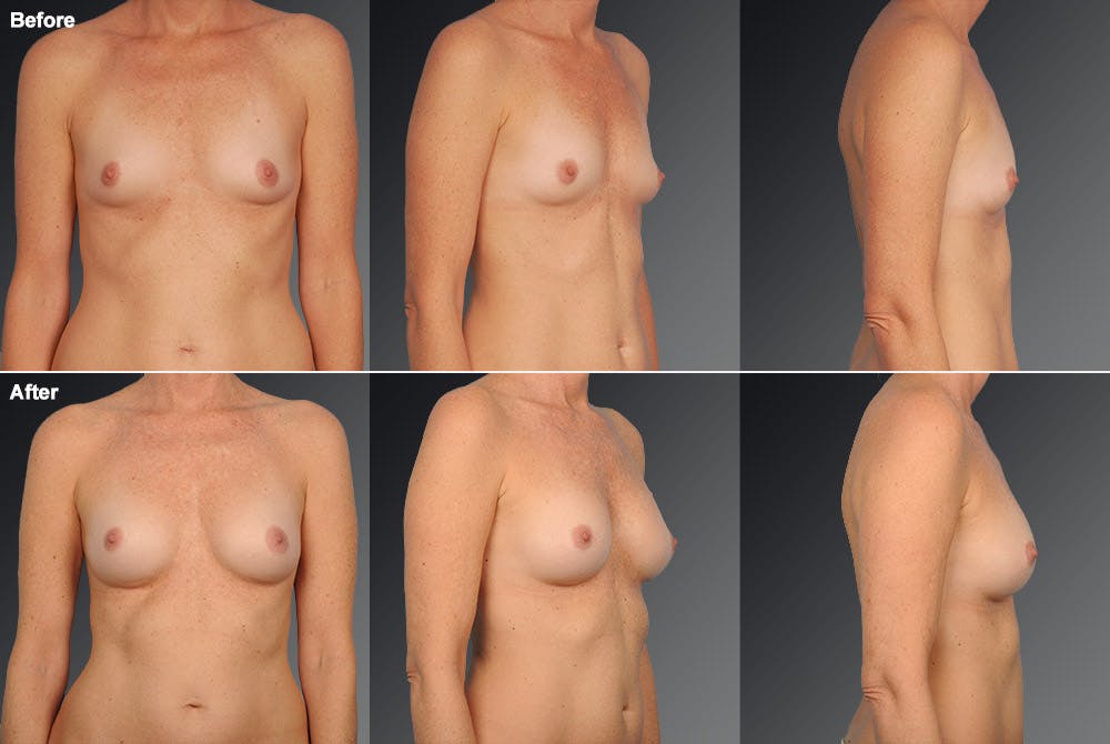 Breast Augmentation Before & After Gallery - Patient 104110563 - Image 1
