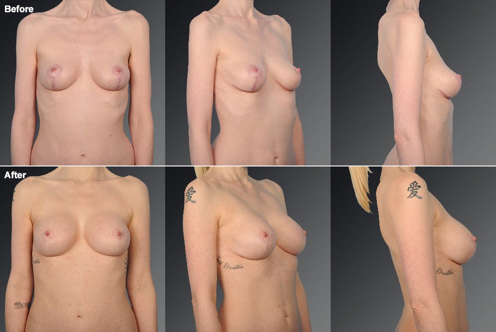 Breast Augmentation Before & After Gallery - Patient 104110565 - Image 1