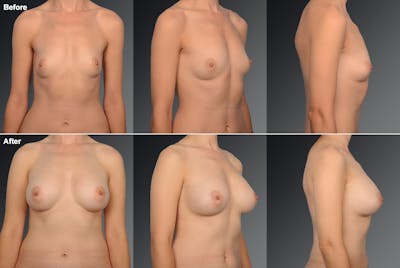 Breast Augmentation Before & After Gallery - Patient 104110566 - Image 1