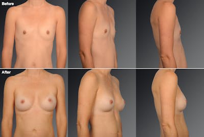 Breast Augmentation Before & After Gallery - Patient 104110568 - Image 1