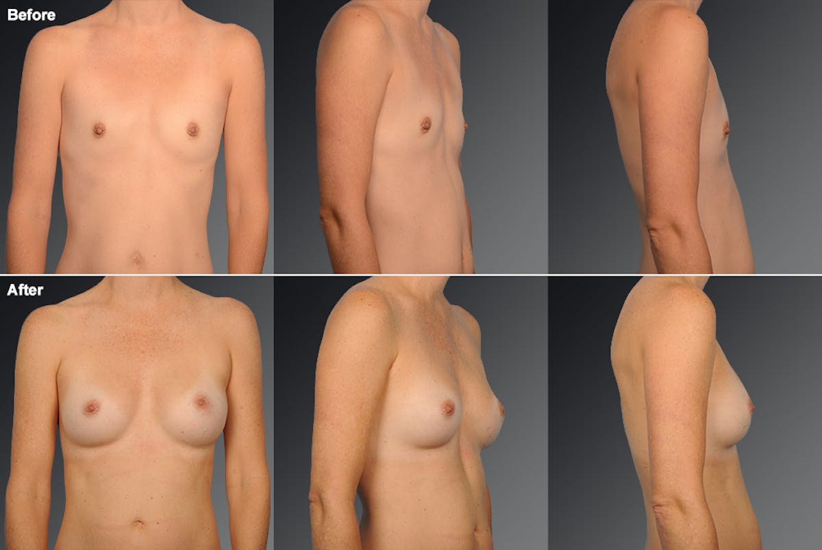 Breast Augmentation Before & After Gallery - Patient 104110568 - Image 1