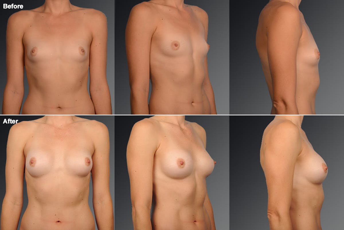Breast Augmentation Before & After Gallery - Patient 104110569 - Image 1
