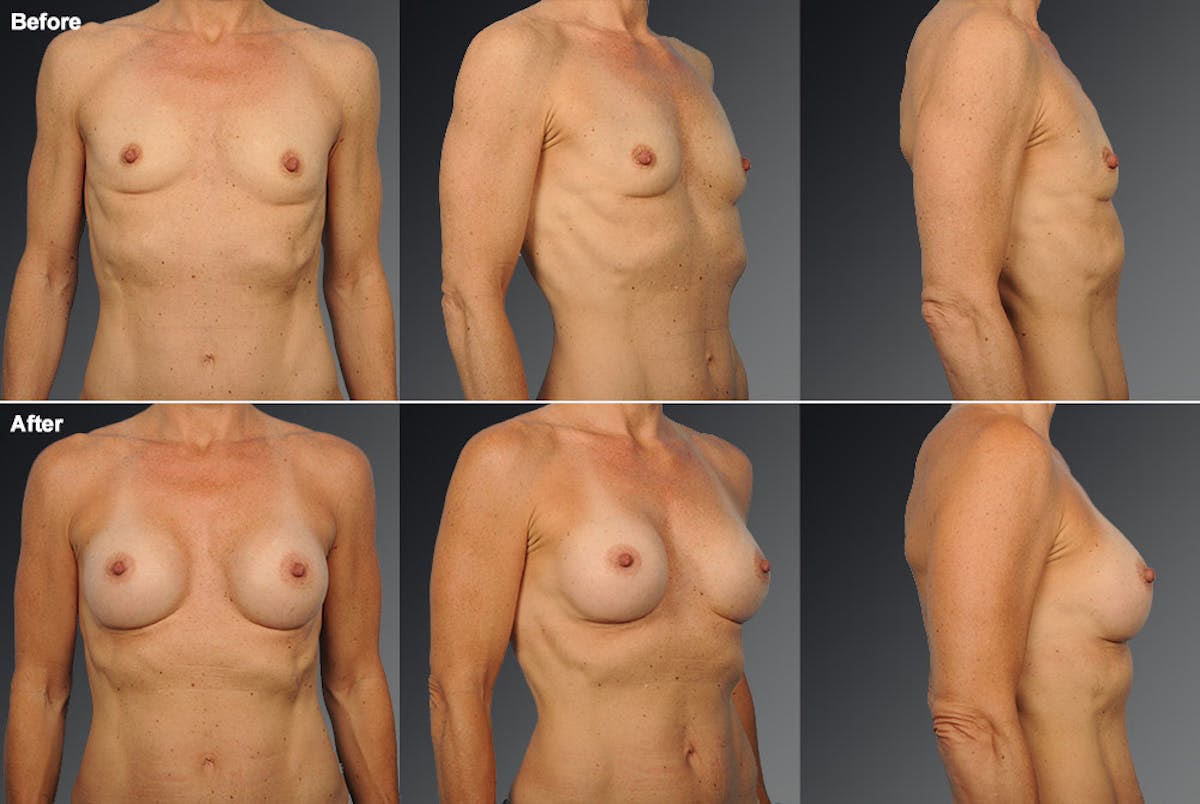 Breast Augmentation Before & After Gallery - Patient 104110576 - Image 1