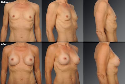 Breast Augmentation Before & After Gallery - Patient 104110576 - Image 1