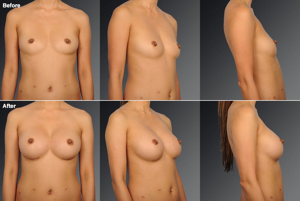 Breast Augmentation Before & After Gallery - Patient 104110578 - Image 1