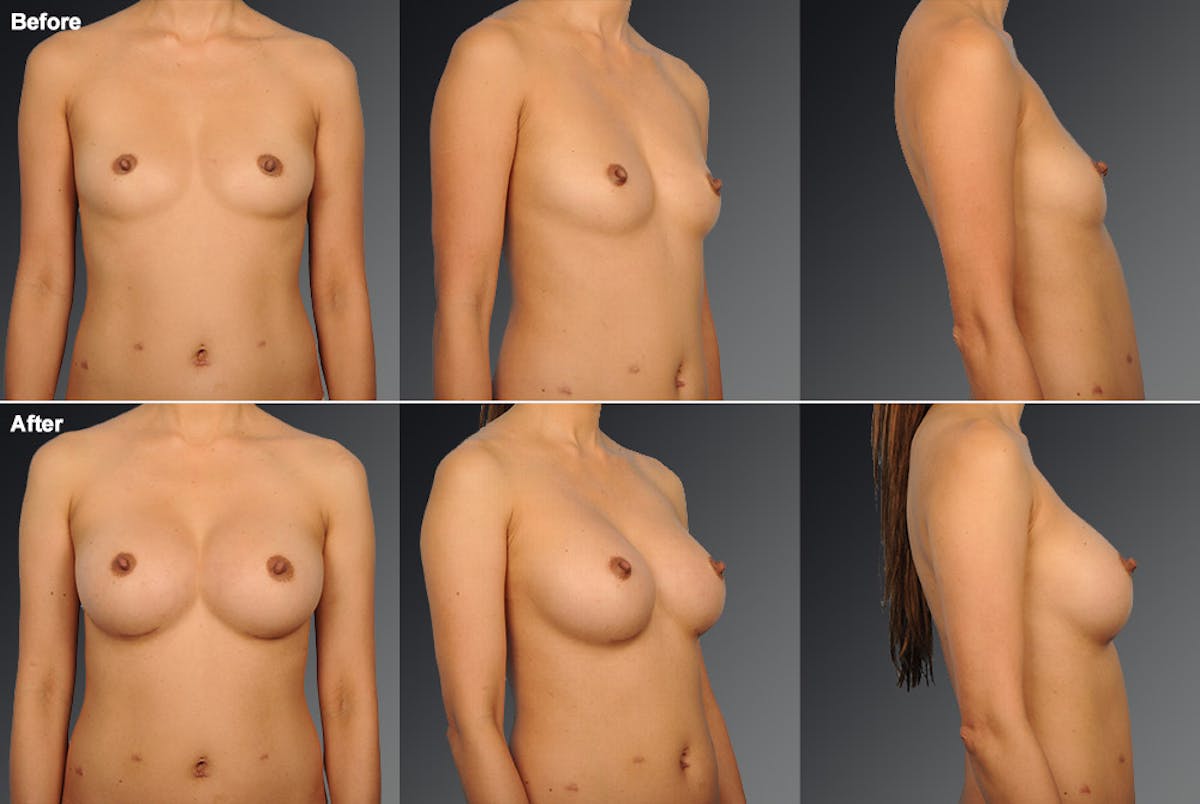 Breast Augmentation Before & After Gallery - Patient 104110578 - Image 1