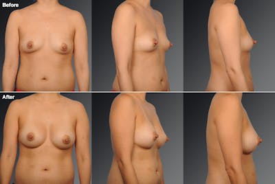 Breast Augmentation Before & After Gallery - Patient 104110579 - Image 1