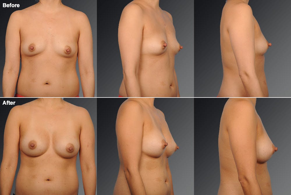 Breast Augmentation Before & After Gallery - Patient 104110579 - Image 1