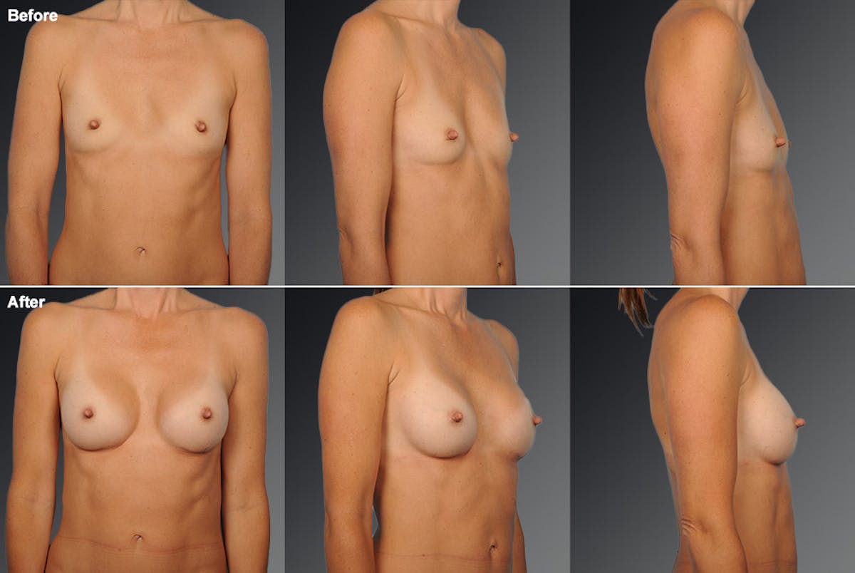 Breast Augmentation Before & After Gallery - Patient 104110581 - Image 1