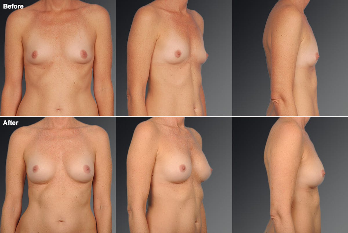 Breast Augmentation Before & After Gallery - Patient 104110585 - Image 1