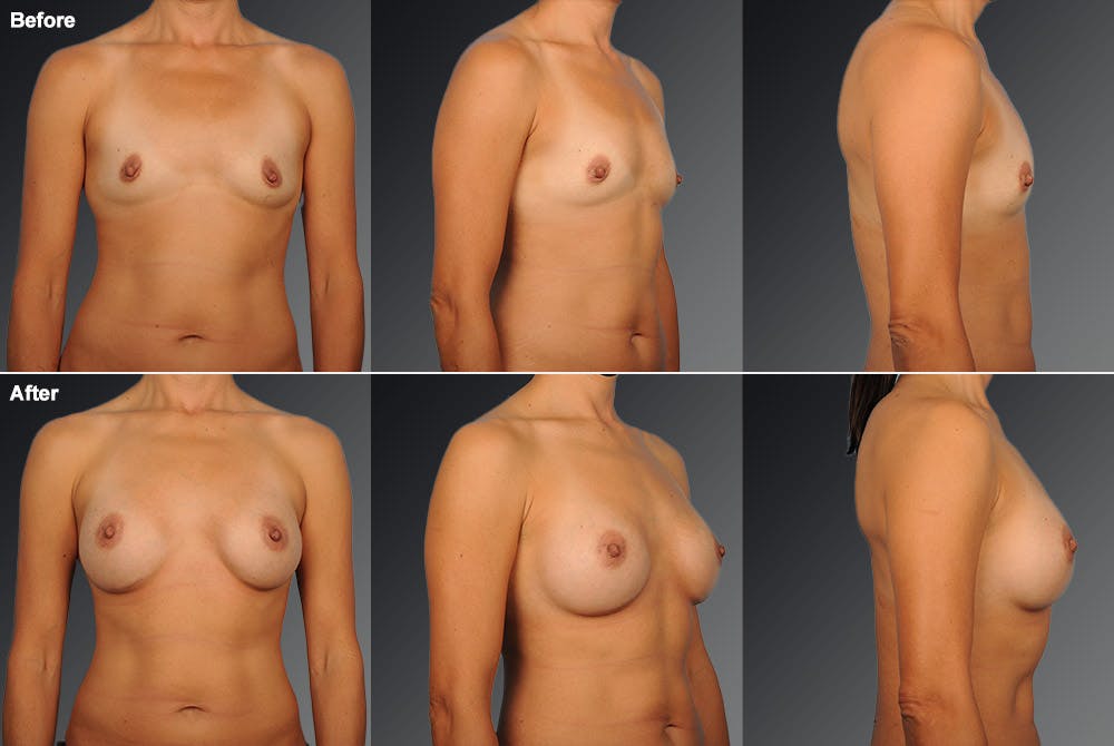 Breast Augmentation Before & After Gallery - Patient 104110594 - Image 1