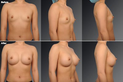 Breast Augmentation Before & After Gallery - Patient 104110596 - Image 1