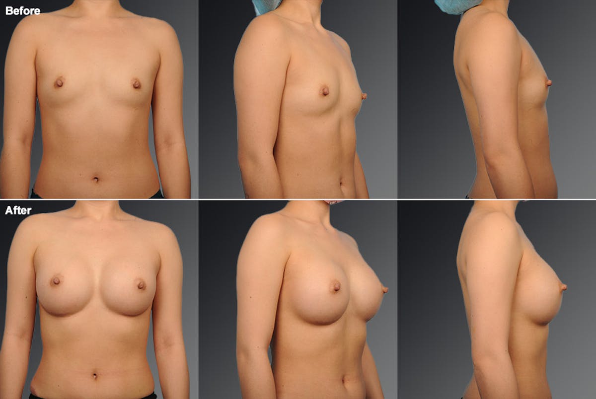 Breast Augmentation Before & After Gallery - Patient 104110596 - Image 1
