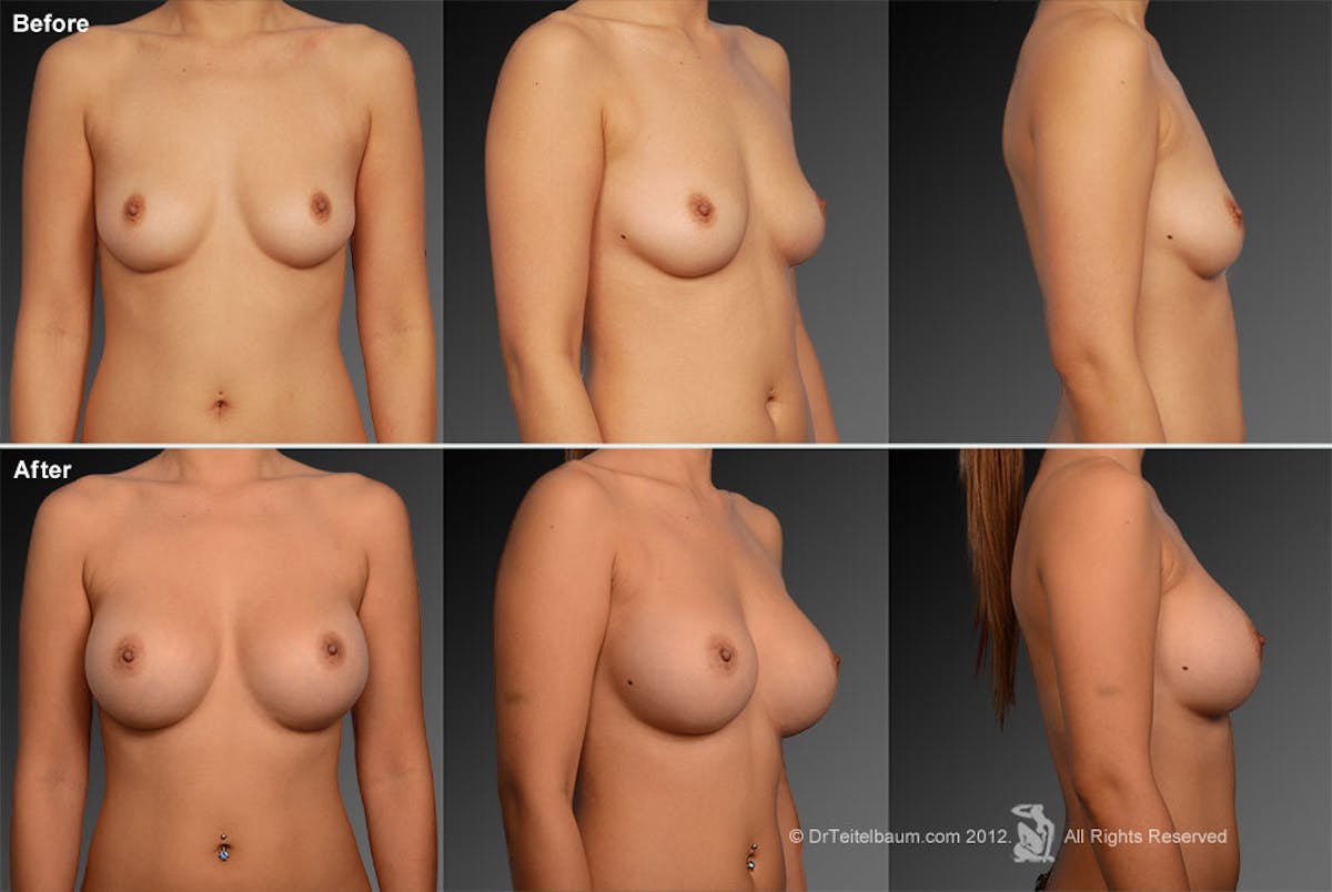 Breast Augmentation Before & After Gallery - Patient 104110675 - Image 1