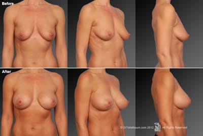 Breast Augmentation Before & After Gallery - Patient 104110682 - Image 1