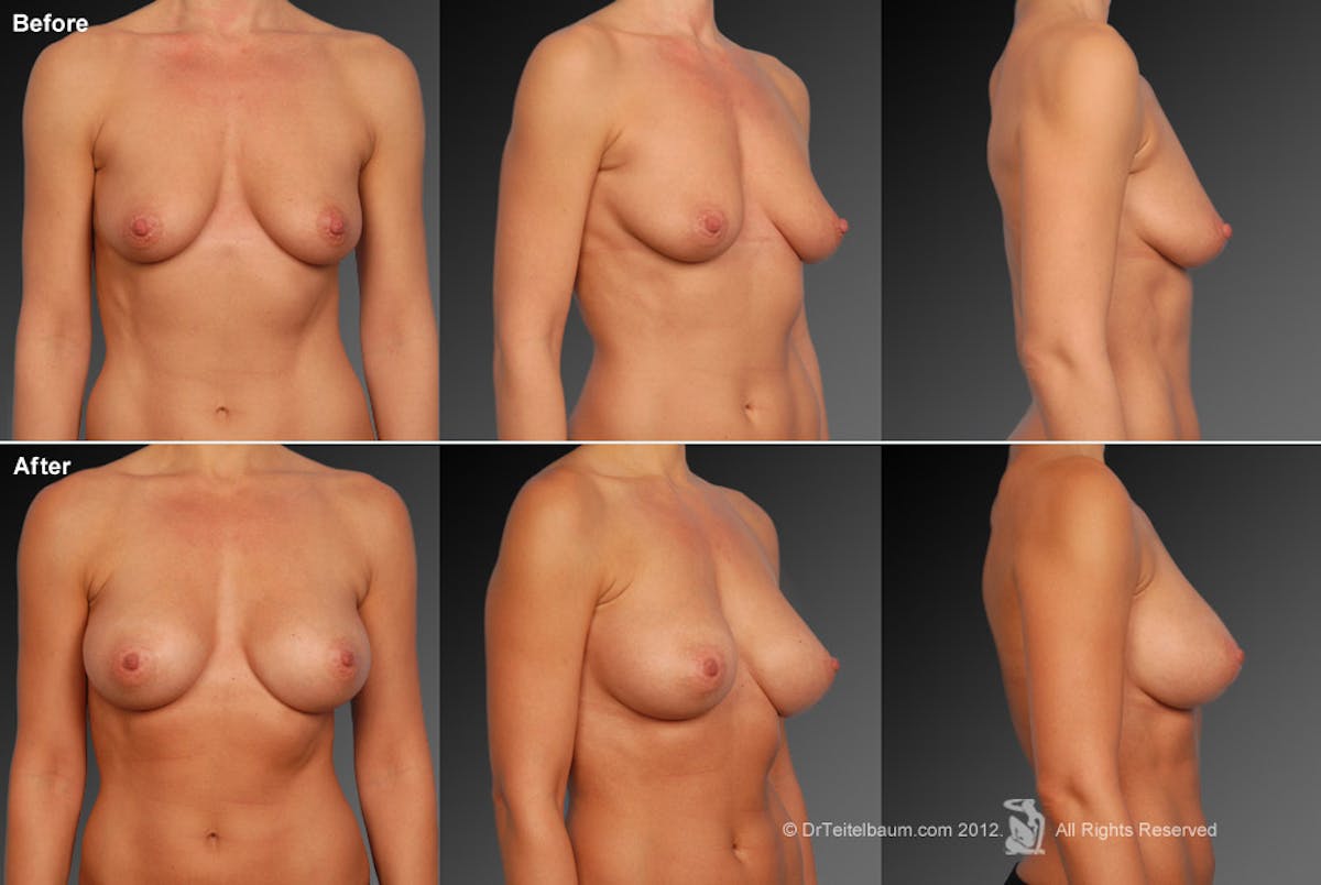Breast Augmentation Before & After Gallery - Patient 104110682 - Image 1