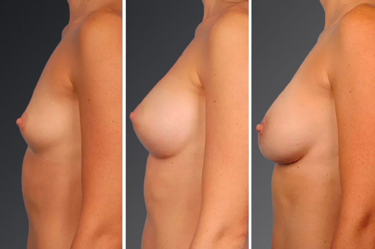 Breast Augmentation Before & After Gallery - Patient 104110692 - Image 1
