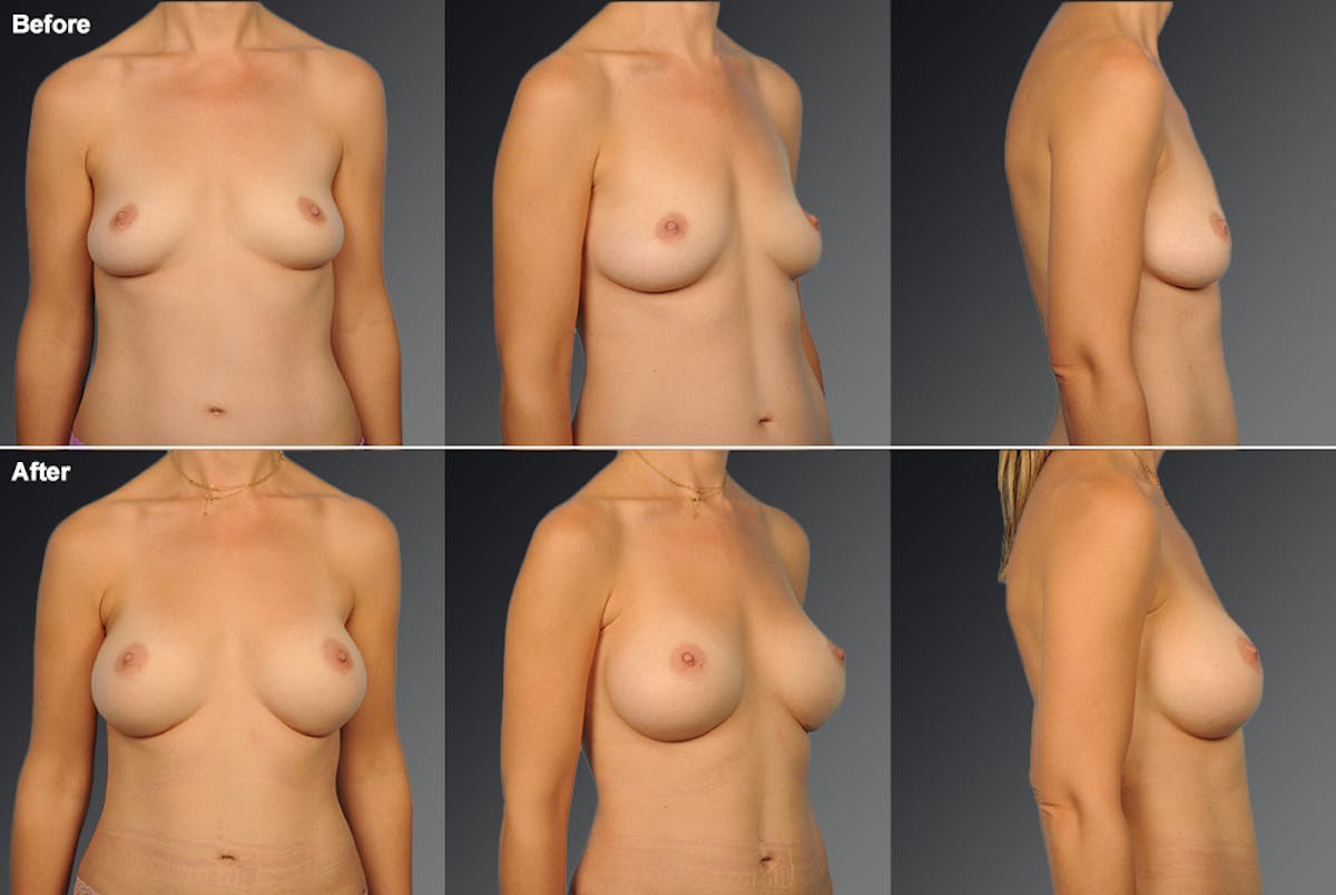 Breast Augmentation Before & After Gallery - Patient 104110706 - Image 1
