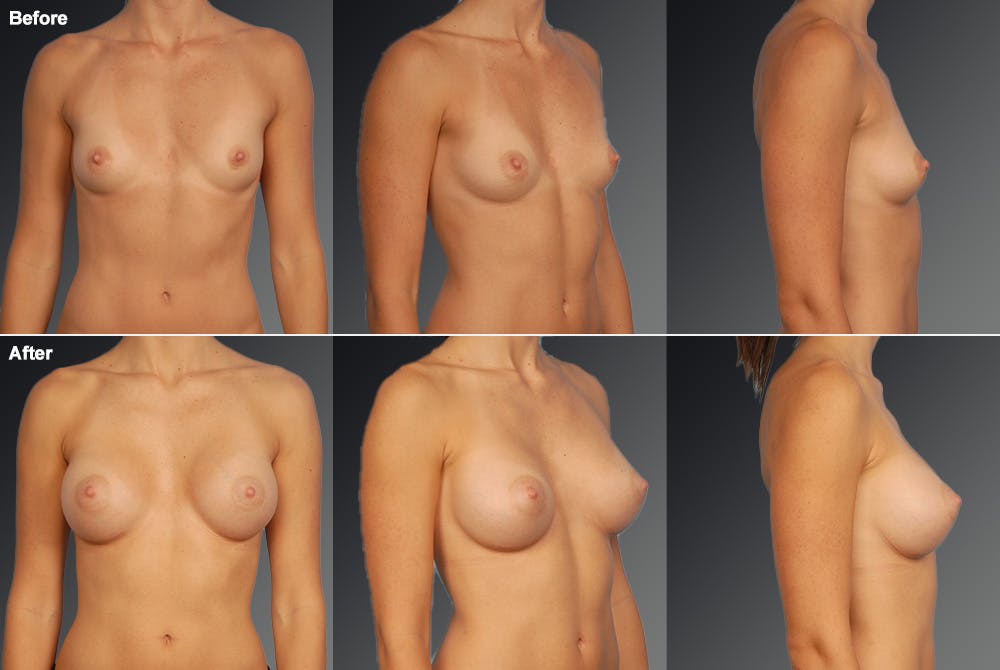 Breast Augmentation Before & After Gallery - Patient 104110707 - Image 1