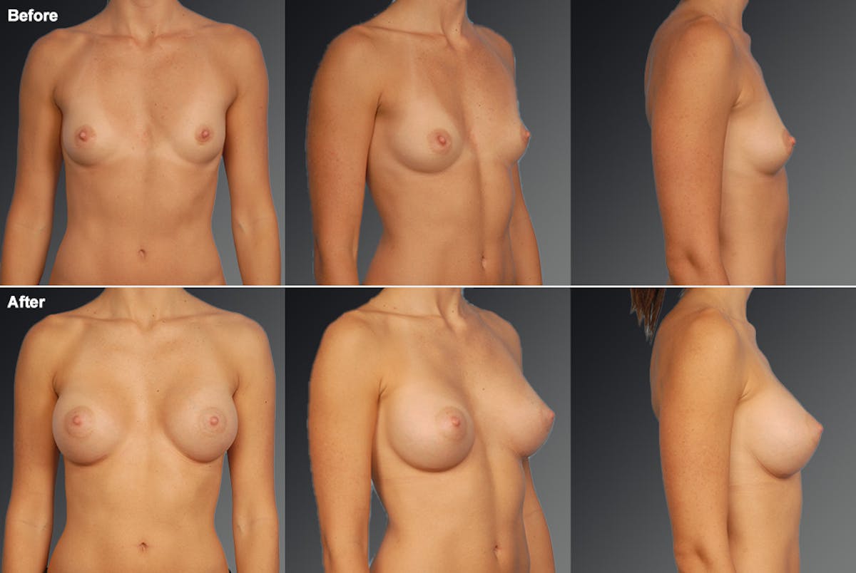 Breast Augmentation Before & After Gallery - Patient 104110707 - Image 1