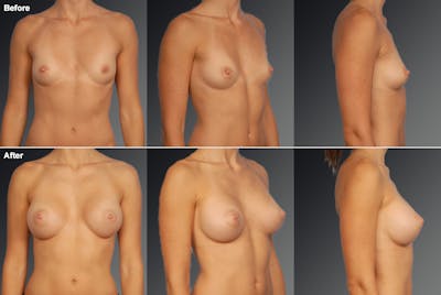 Breast Augmentation Before & After Gallery - Patient 104110707 - Image 1