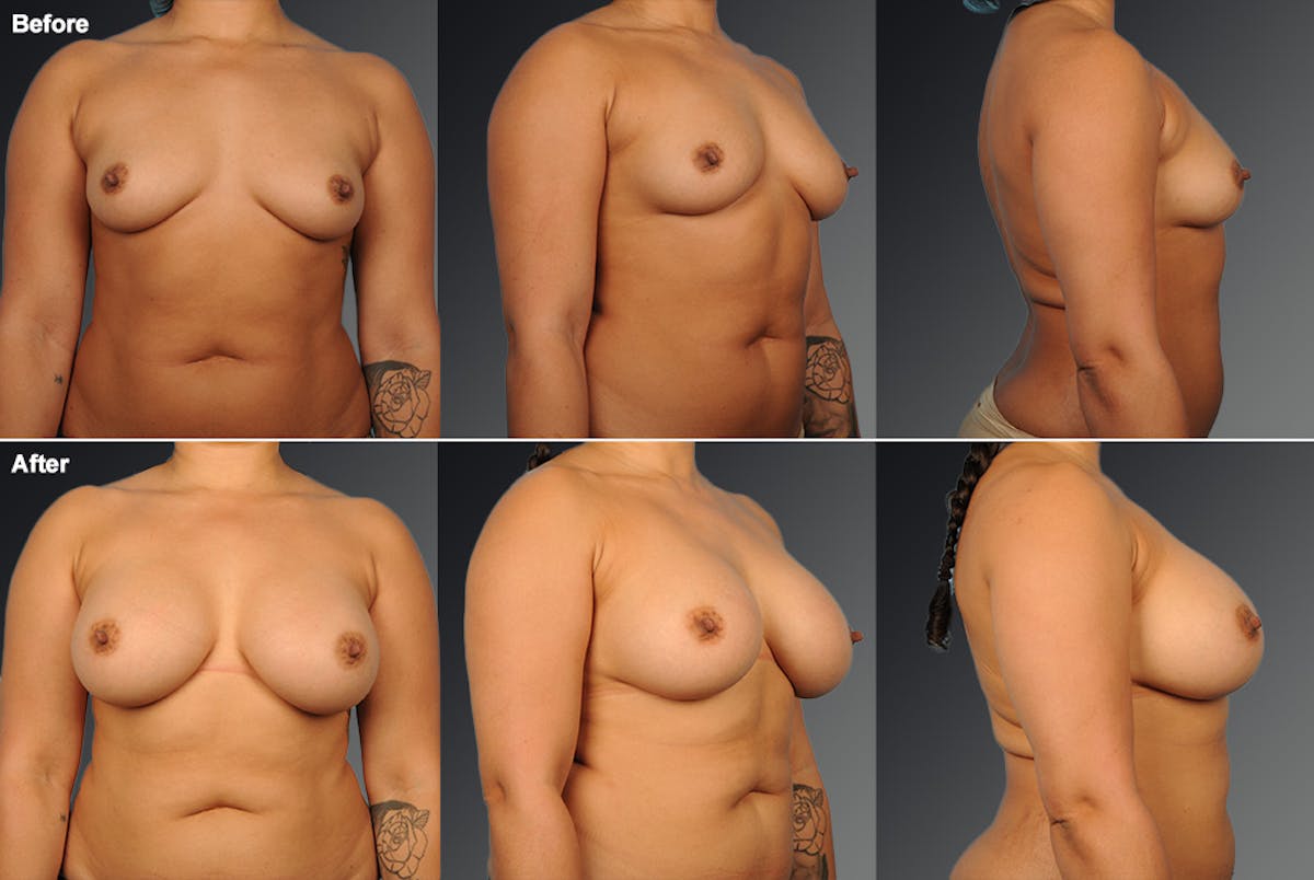 Breast Augmentation Before & After Gallery - Patient 104110708 - Image 1