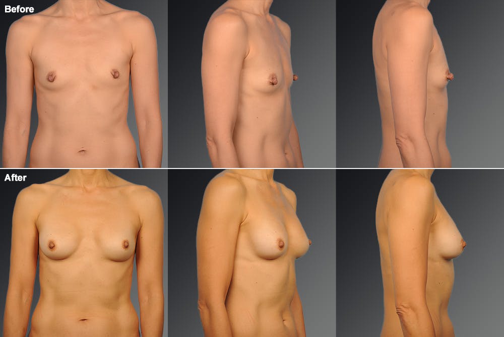 Breast Augmentation Before & After Gallery - Patient 104128605 - Image 1