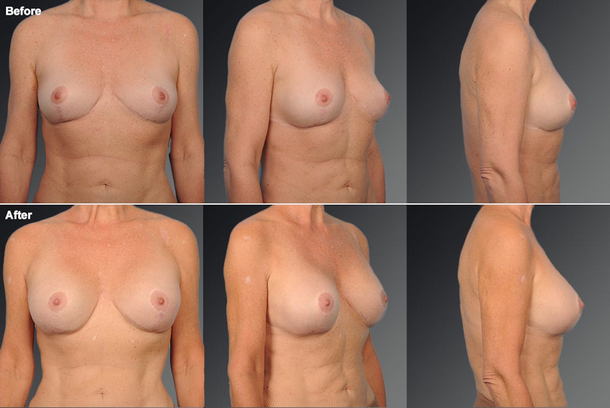 Breast Augmentation Before & After Gallery - Patient 104128611 - Image 1