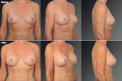 Breast Augmentation Before & After Gallery - Patient 104128611 - Image 1