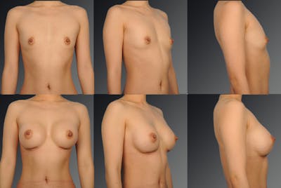 Breast Augmentation Before & After Gallery - Patient 104249142 - Image 1