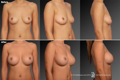 Breast Augmentation Before & After Gallery - Patient 104258143 - Image 1