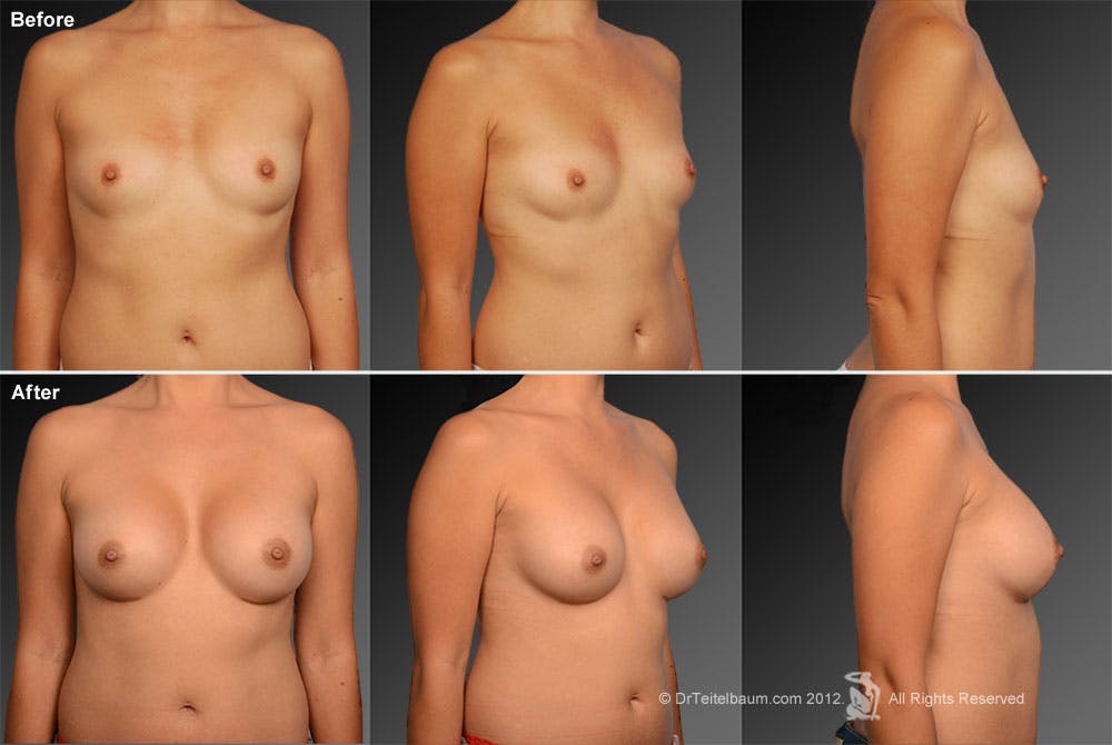 Breast Augmentation Before & After Gallery - Patient 104267031 - Image 1