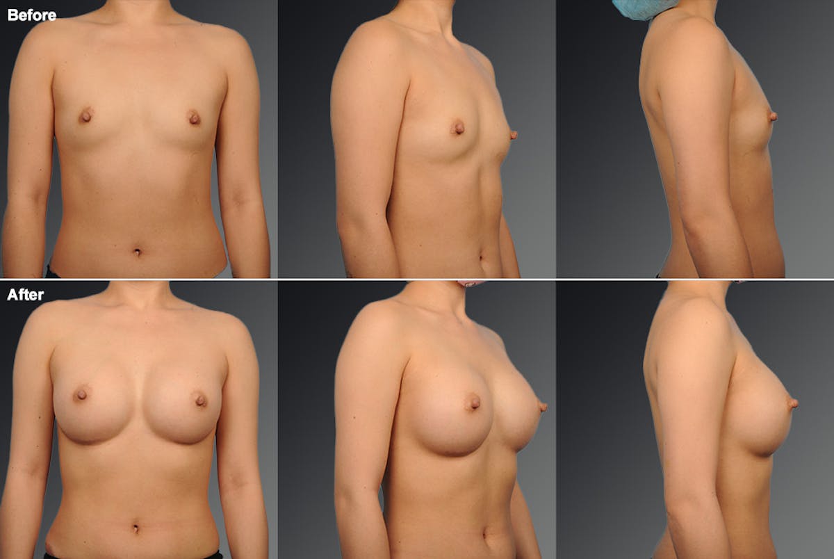 Breast Augmentation Before & After Gallery - Patient 104267032 - Image 1
