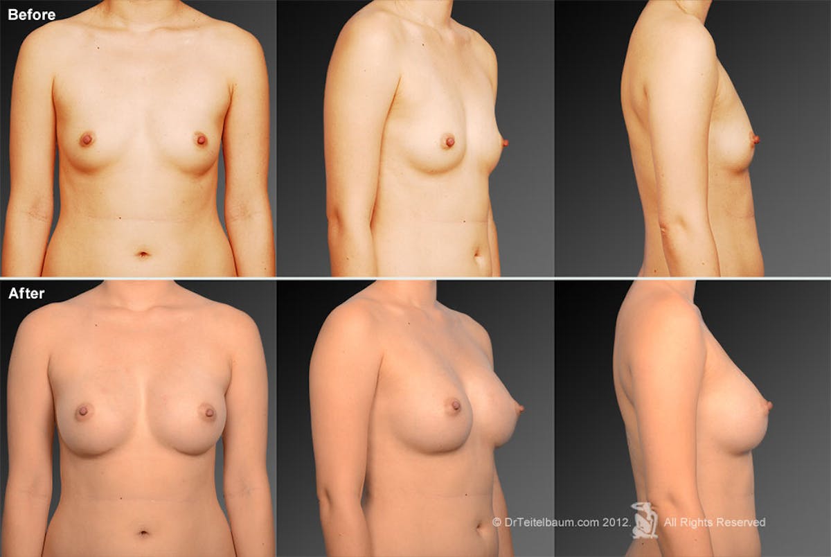 Breast Augmentation Before & After Gallery - Patient 104267033 - Image 1